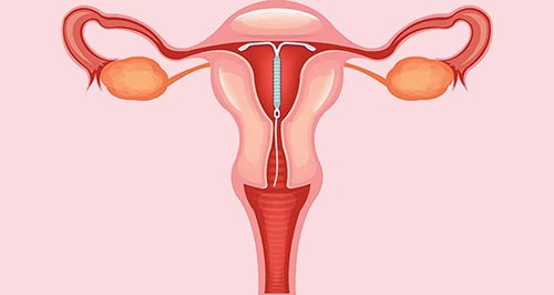 hết kinh bao lâu thì đặt vòng được? tìm hiểu vòng tránh thai